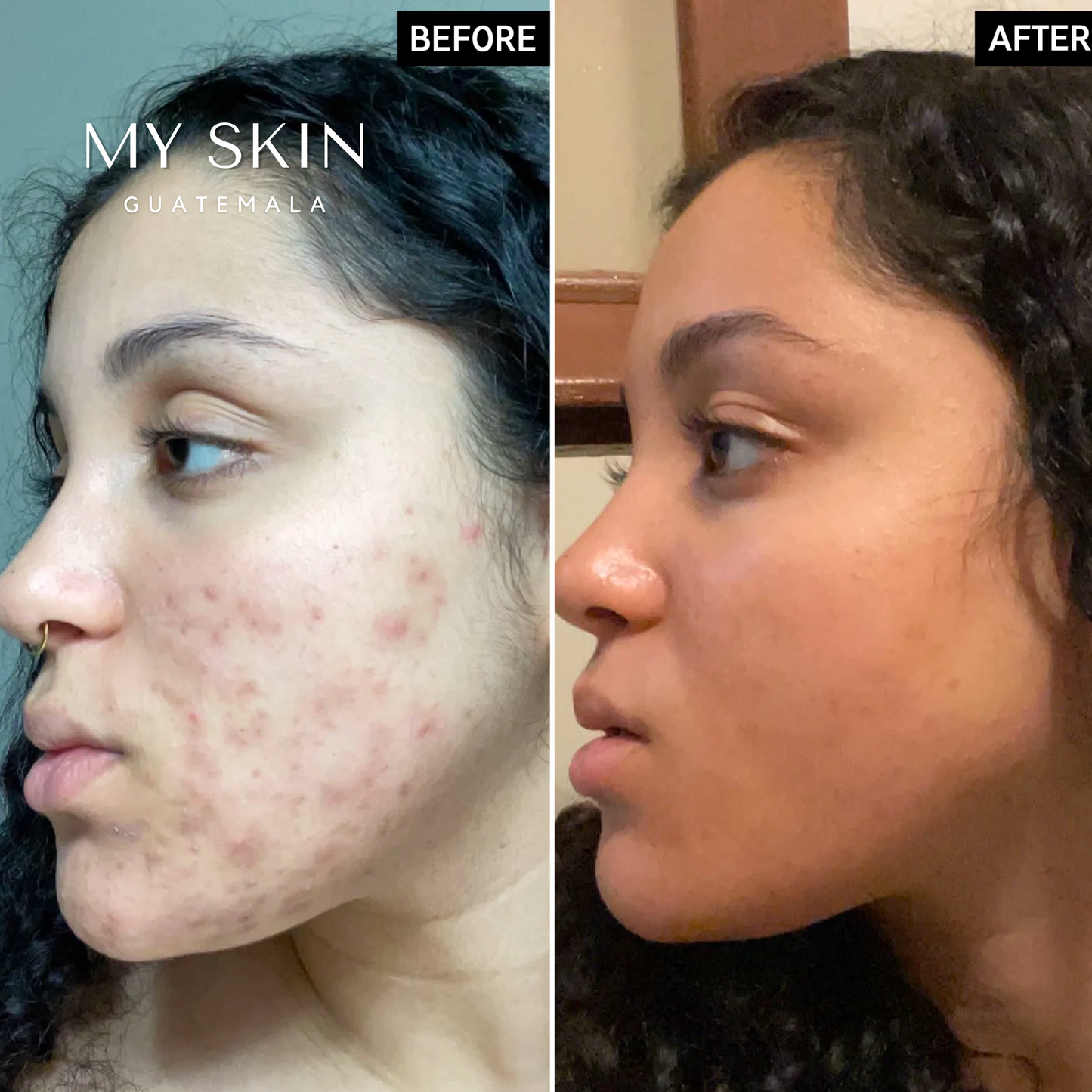 Tranexamic Acid Serum - Tratamiento para Hiper-pigmentación