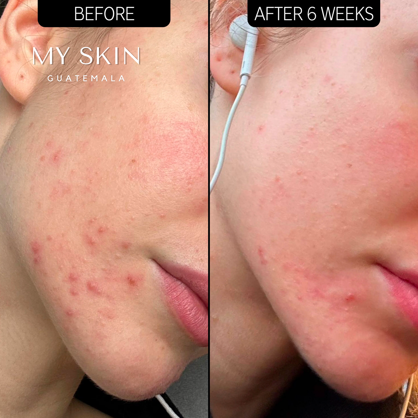 Acne Clearing Moisturizer 2% NOVORETINᵀᴹ - Humectante anti-acné